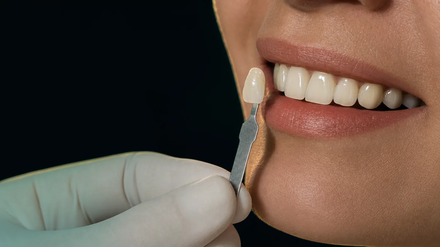 Shade matching a ceramic veneer against a patient's natural teeth